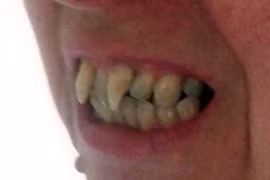 Rùng rợn người đàn bà mọc răng ma cà rồng do viêm nướu