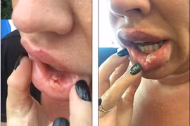 Hãi hùng cô gái môi thủng lỗ chỗ vì nghiện tiêm botox