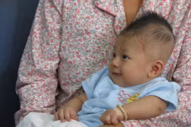 Di chứng bệnh viêm màng não ở bé bị đâm xuyên sọ