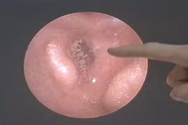 Nổi gai ốc clip hàng trăm con giòi ký sinh trong tai