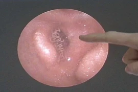 Nổi gai ốc clip hàng trăm con giòi ký sinh trong tai