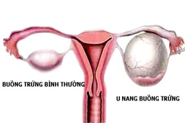 Sự thật cần biết về u nang buồng trứng, mọi phụ nữ cần biết