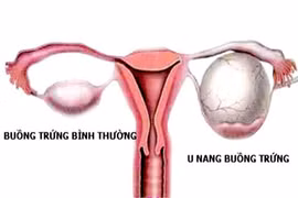 Sự thật cần biết về u nang buồng trứng, mọi phụ nữ cần biết