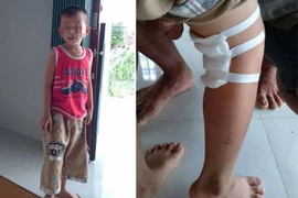 Kỷ luật hai bác sĩ mổ nhầm chân bé 6 tuổi