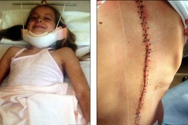 Hành trình 10 năm nắn cột sống cong vẹo của thiếu nữ đẹp