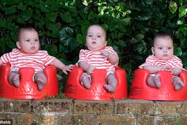 Lạ lùng ca sinh ba có 2 bé chung nhau thai và bọc ối