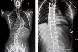 Hành trình uốn xương cực nhọc của cô bé vẹo cột sống