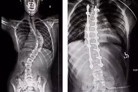 Hành trình uốn xương cực nhọc của cô bé vẹo cột sống