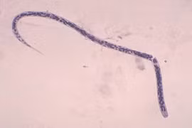 10 loại ký sinh trùng trong mắt có thể gây mù