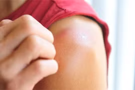 Cách trị da khô, ngứa sau hóa trị ung thư