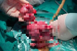 Tử cung 'mọc' u chi chít do trì hoãn điều trị