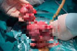 Tử cung 'mọc' u chi chít do trì hoãn điều trị