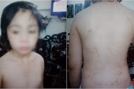 Chủ tịch Hà Nội chỉ đạo khẩn trương điều tra vụ bé trai bị bạo hành 