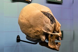 Phát hiện hộp sọ “người ngoài hành tinh” dị thường gắn kim loại