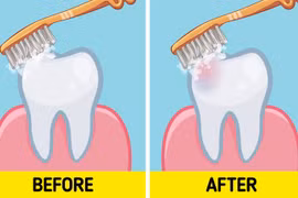 Nha sĩ bật mí thắc mắc nên đánh răng trước hay sau khi ăn sáng