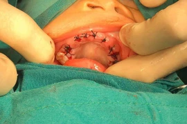 Các mẹ cần lưu ý gì khi bé 4 tuổi bị thối 20 răng sữa?