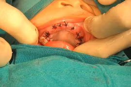 Các mẹ cần lưu ý gì khi bé 4 tuổi bị thối 20 răng sữa?