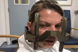 Đi khám đau đầu không ngờ phát hiện 16 khối u ác tính trong não