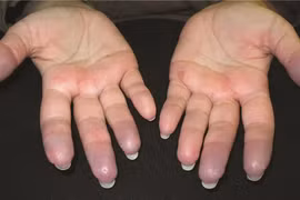 Nhiệt độ xuống thấp “phi mã” gây hại cho cơ thể thế nào?