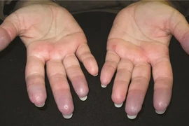 Nhiệt độ xuống thấp “phi mã” gây hại cho cơ thể thế nào?