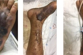 Ăn hải sản sống, một người Hải Phòng nhiễm khuẩn máu dẫn tới tử vong 