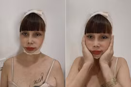 Gương mặt biến dạng kinh hoàng vì “dao kéo” của cô dâu 62 tuổi