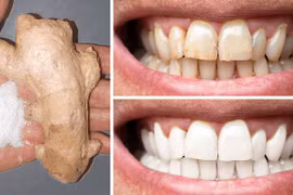 Bí kíp làm trắng răng tại nhà hiệu quả