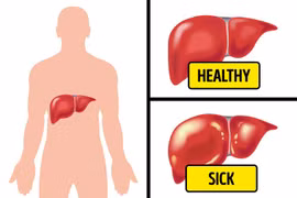 Chứng đầy hơi có thể là dấu hiệu 6 căn bệnh nguy hiểm cần cảnh giác