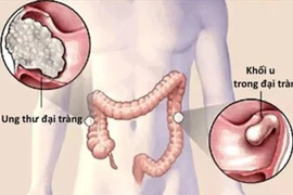 Bé 9 tuổi ung thư đại trực tràng, thói quen ăn uống tai hại