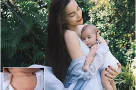 Con gái Hà Hồ mẩn đỏ khắp người: Nguyên nhân, xứ lý thế nào?