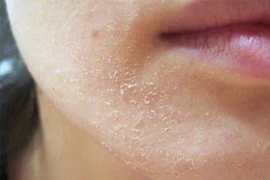 Cách chăm sóc da mùa hanh khô hiệu quả nhất