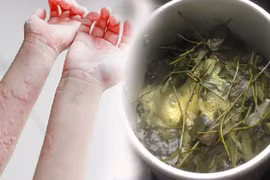 7 loại lá tắm vườn nhà chữa mẩn ngứa, nổi mề đay cực nhạy
