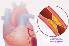 Cụ bà tử vong trên máy bay VNA: Phòng nhồi máu cơ tim thế nào?