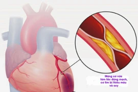 Cụ bà tử vong trên máy bay VNA: Phòng nhồi máu cơ tim thế nào?