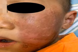 Cảnh giác với mặt nạ hóa trang Halloween khiến bé 4 tuổi bị bỏng rộp da 