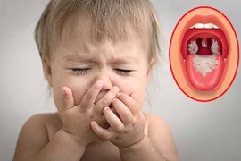 Loạt biến chứng kinh hoàng của bệnh bạch hầu ai cũng cần biết