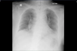 Người bệnh đái tháo đường lưu ý gì khi mắc cúm?