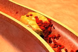 Bệnh huyết khối và 4 dấu hiệu nhận biết ở chân 