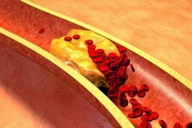 Bệnh huyết khối và 4 dấu hiệu nhận biết ở chân 