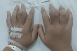 Bé 3 tuổi mắc bệnh gút, giật mình nguyên nhân