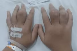 Bé 3 tuổi mắc bệnh gút, giật mình nguyên nhân