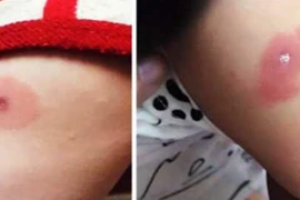 Con sốt cao, nổi vòng tròn đỏ lạ lùng, bác sĩ thở dài vì bạo bệnh 
