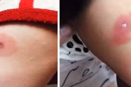 Con sốt cao, nổi vòng tròn đỏ lạ lùng, bác sĩ thở dài vì bạo bệnh 