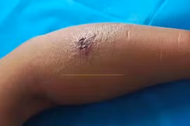 Người đàn ông bị hoại tử, suýt phải cắt cụt chi vì muỗi đốt