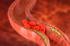 5 triệu chứng xuất hiện ở tay chân có thể tồn tại cục máu đông