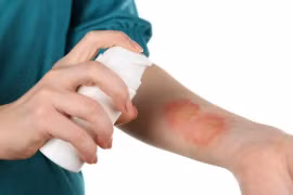 Những loại sẹo có nguy cơ trở thành ung thư 