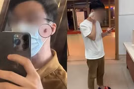 Thanh niên suýt hỏng luôn mặt vì tự nặn mụn tại nhà