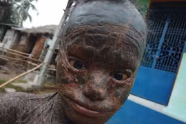 Căn bệnh lạ biến cậu bé thành "quái nhân", 6 tuần thay da một lần