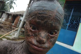 Căn bệnh lạ biến cậu bé thành "quái nhân", 6 tuần thay da một lần