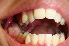 Sau nhổ răng khôn, thanh niên 18 tuổi ung thư đầy mồm gây sốc